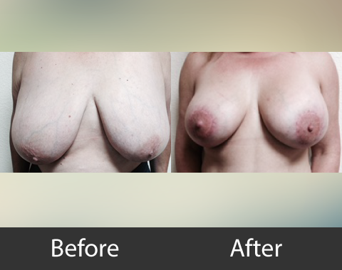 Breast Lift Augmentation